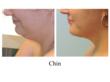 liposuction of chin, chin liposuction, double chin liposuction